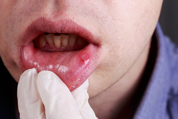 Stomatitis on the lips