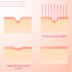 Procedure of laser rejuvenation. Lifting and resurfacing of the skin. Alignment of wrinkles.