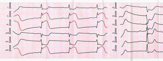 ECG tape with sharpest period of macrofocal posterior diaphragmatic myocardial infarction