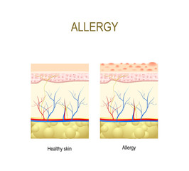 Allergy. healthy and skin with allergic reaction.
