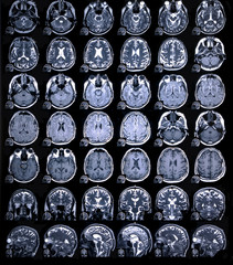 MRI scan or magnetic resonance image of head and brain scan. Close up view