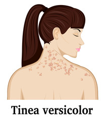 Illustration of Tinea versicolor