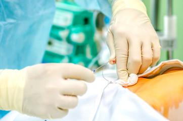 The process of setting the central catheter before the operation.