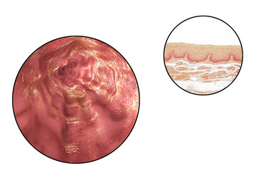 Human esophagous, 3D illustration and light micrograph of esophageal non-keratinized stratified squamous epithelium