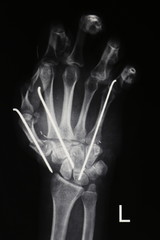 X-ray image of cut off and re-connected hand surgery 