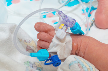 Peripheral intravenous catheter in the vein of newborn baby foot