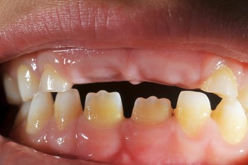 Milchzahngebiss eines 6-j&auml;hrigen Jungen (Dens&nbsp;caducus)