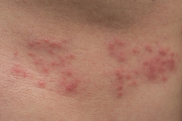 Fototapeta premium Closeup of body skin with Herpes Zoster (Shingles)