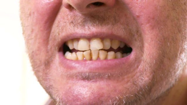 Closeup of man showing yellow teeth