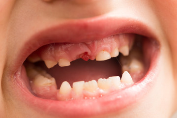Obraz premium The mouth of a boy without a tooth