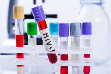 tubes with hiv test blood samples in laboratory