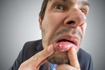 Young man is looking on ulcer or blister in his mouth in mirror.