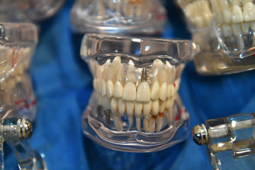 Tooth implant prosthesis
