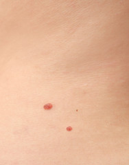 Fototapeta premium Back of woman with birthmark, closeup