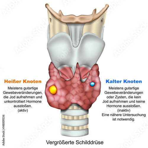 Kleine Knoten In Der Schilddrüse