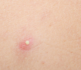 pimple