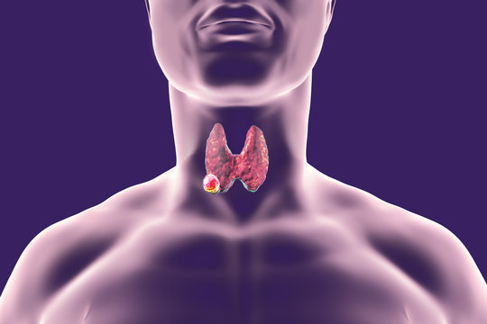 Thyroid cancer. 3D illustration showing thyroid gland with tumor inside human body