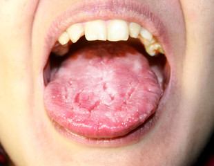 The tongue is in a white raid. Candidiasis in the tongue