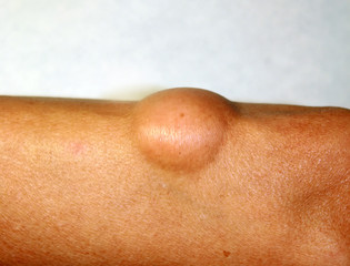 Lipoma on the elbow of the arm