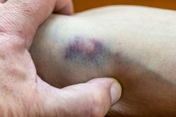 Fototapeta premium ein Mann hat brutal seine Ehefrau misshandelt