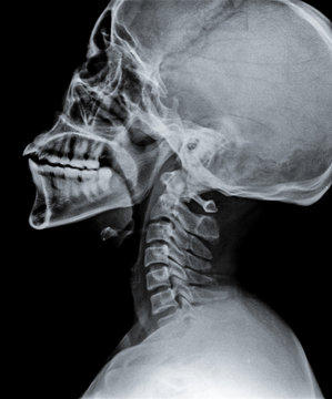 X rays of skull with neck bone.