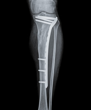 X ray of fractured tibia bone with fibula.