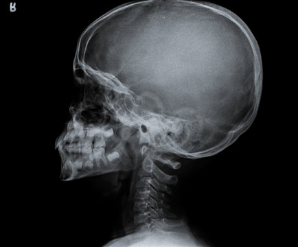 Radiography of human skull side view.