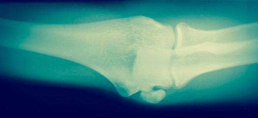 Close up  bone  x-ray
