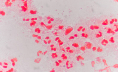 Moderate red white blood cells with gram negative diplococci.