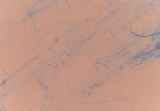 red cells acid fast bacilli