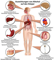 Auswirkungen von Alkohol auf den Körper, Alkoholmissbrauch Infografik - obrazy, fototapety, plakaty