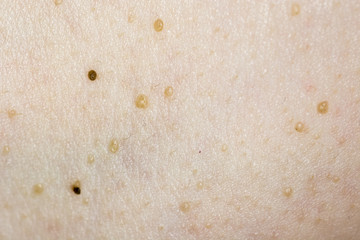 Warts on the skin.