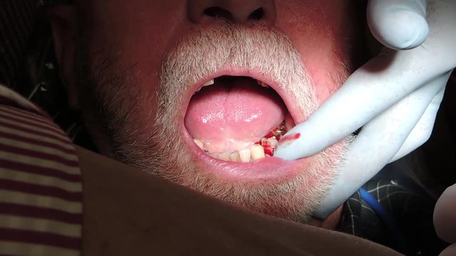 Close up, dentist pulls out man's tooth