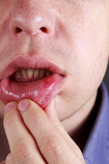 Stomatitis on the lips