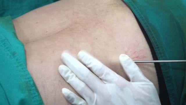 Body Liposculpture Procedure,fat removal, 4K VIDEO