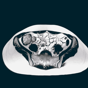 Contrast radiography of the gastrointestinal tract