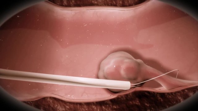 A polyp is a fleshy outgrowth from the inner lining of the colon or rectum. http://www.polymime.com