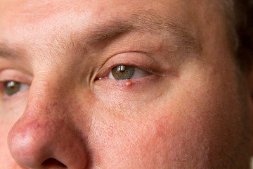 Obraz premium Big pimple on the skin of the lower eyelid on the man's face.