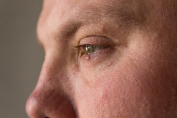 Obraz premium Big pimple on the skin of the lower eyelid on the man's face.
