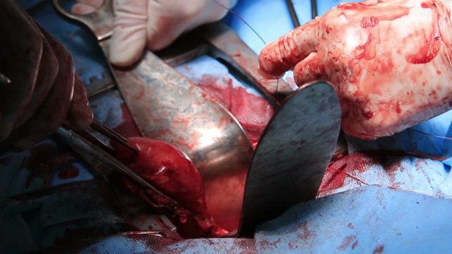 Uterus removal surgery close up with surgeon ties a knot