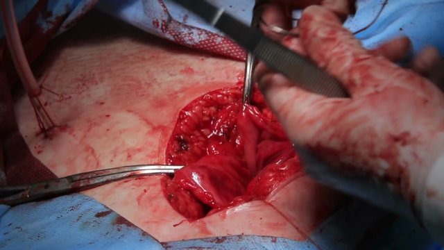 Bloody close-up during the surgery with open wound sewing at stomach