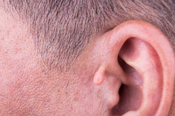 Fototapeta premium Human mutation with extra growth on ear