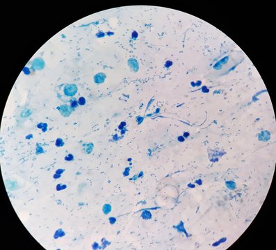 Smear of Acid-Fast bacilli (AFB) stained from sputum specimen, under 100X light microscope. White blood cells, epithelial cell and many types of bacteria are found in this smear. Selective focus.