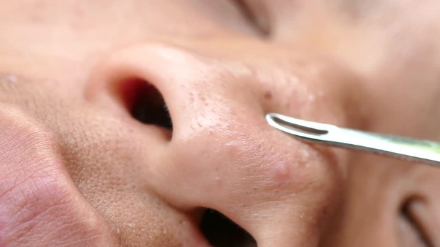 Squeezing pimple with comedone extractor tool
