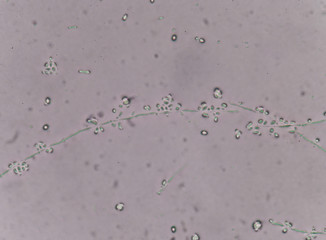 Yeast cells in urine specimens.