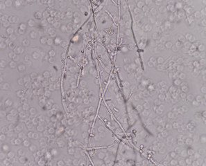 yeast cells in urine sample.