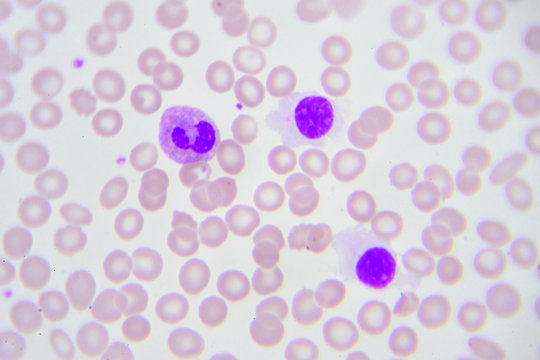 White blood cells in in blood smear, analyze by microscope
