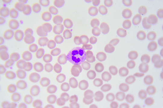 Neutrophil cell (white blood cell) in blood smear, analyze by microscope

