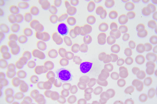 Leukemia cells in blood smear

