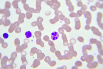 White blood cells in in blood smear, analyze by microscope
